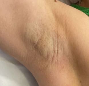 Кожа после курса процедур лазерной эпиляции